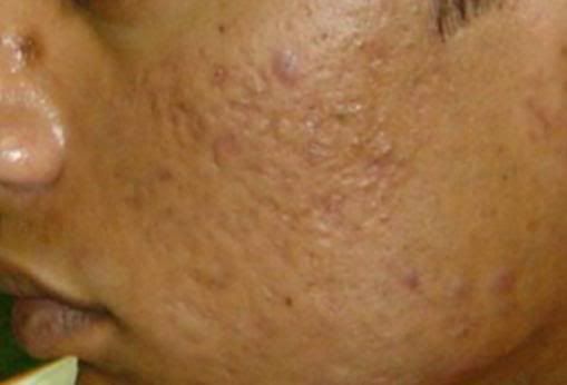 Acne Scars Pictures, Images and Photos