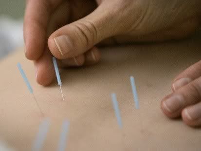 acupuncture Pictures, Images and Photos